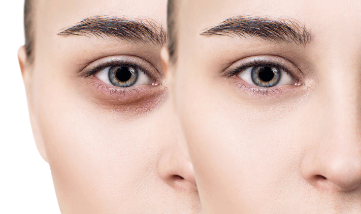 درمان سیاهی دور چشم