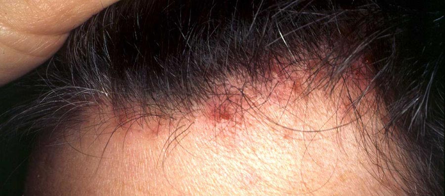 عکس پسوریازیس خفیف سر