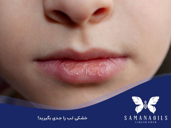 خشکی لب را جدی بگیرید