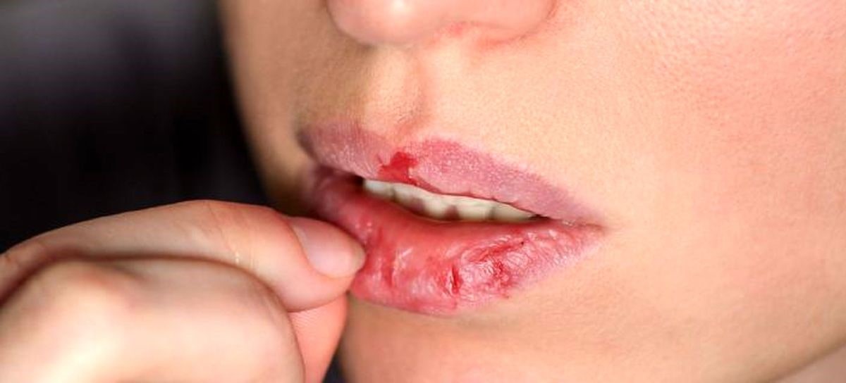 رفع خشکی لب