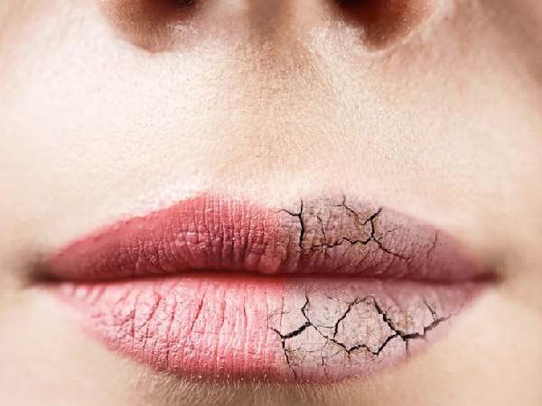 علل خشکی لب