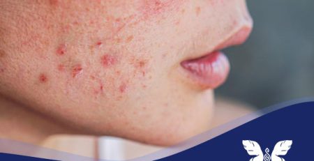 رفع لک های پوستی صورت