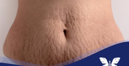 جلوگیری از ترک شکم در بارداری