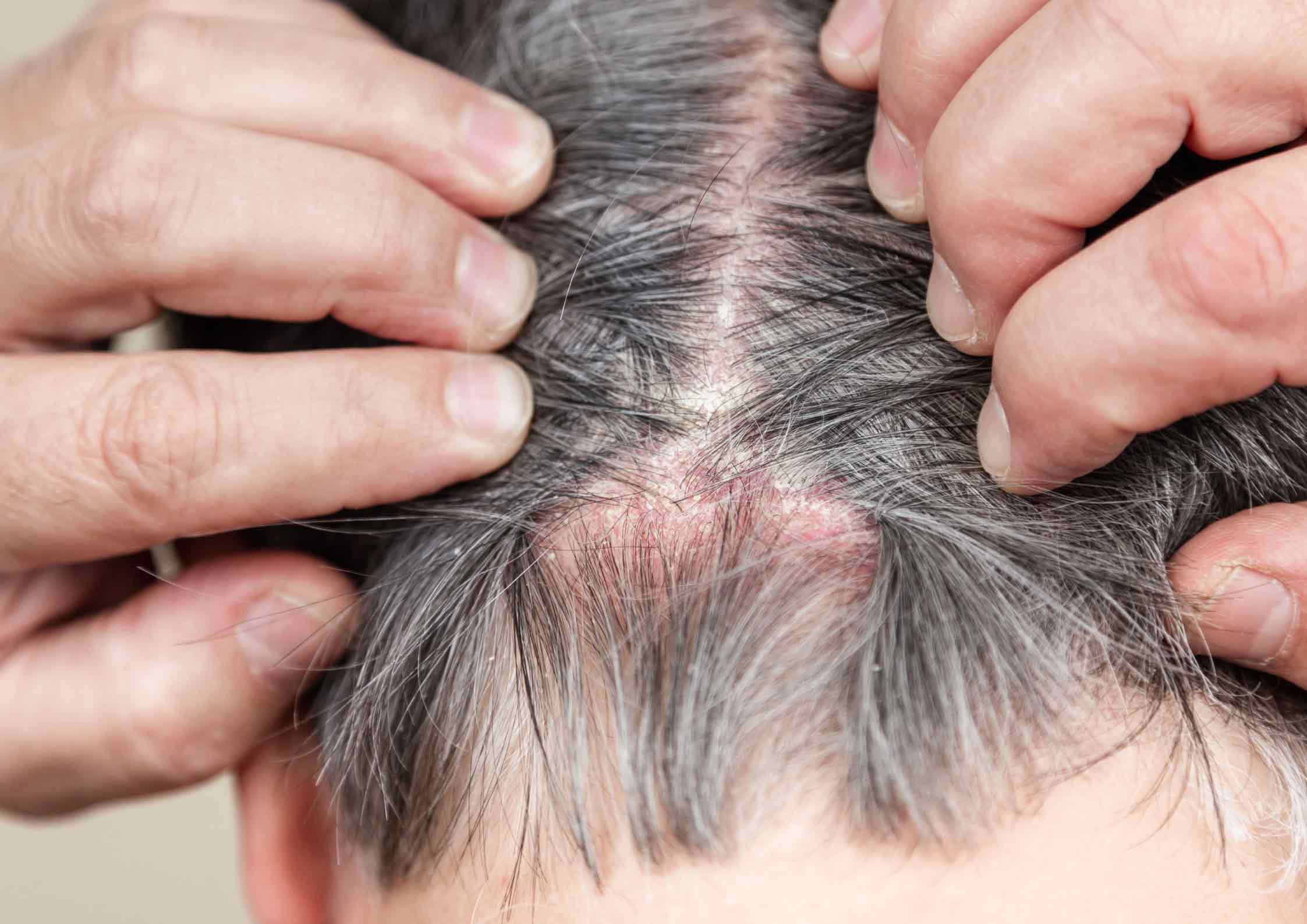 علت زخم پوست سر