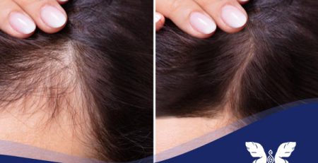 بهترین روغن گیاهی برای ریزش مو