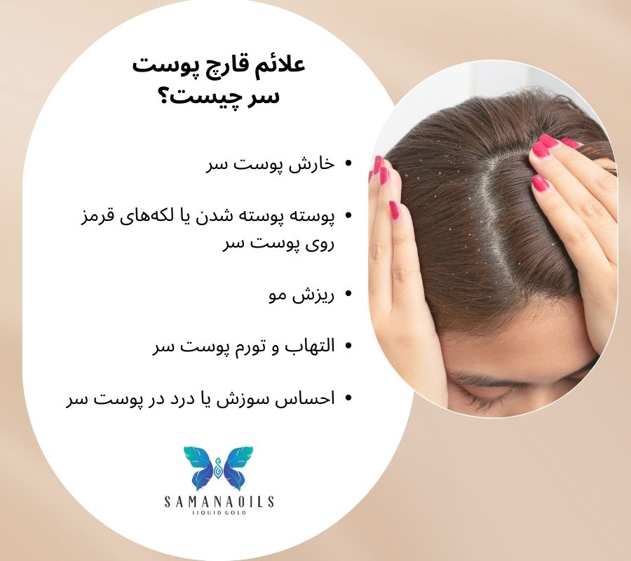 علائم قارچ پوست سر چیست؟