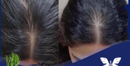 روغن رزماری برای ریزش مو