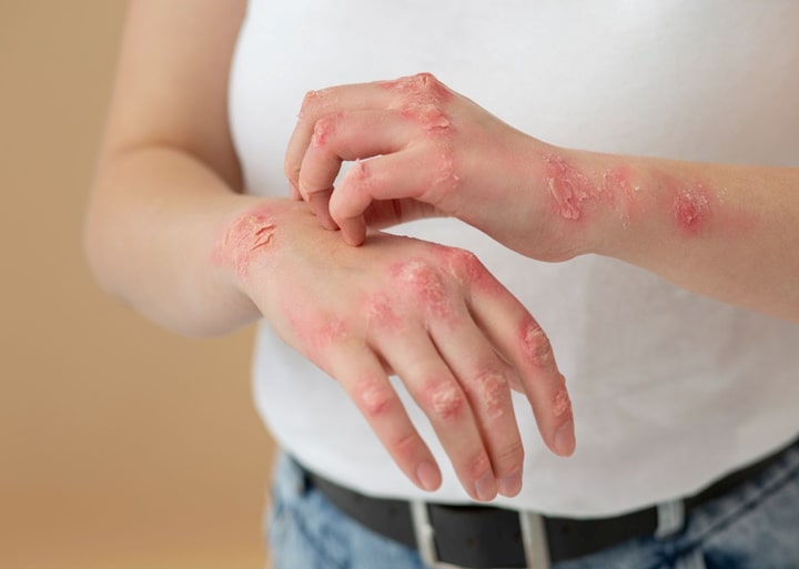 اگزما دست