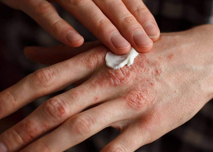 روش های پیشگیری از اگزمای دست