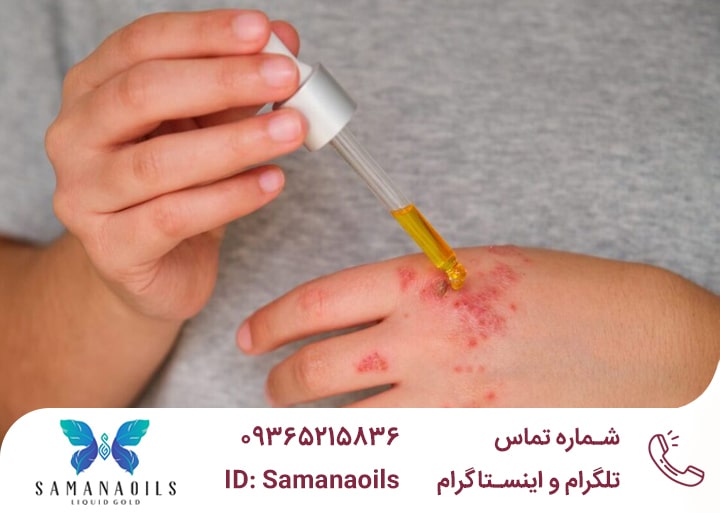 درمان اگزما دست با روغنهای گیاهی