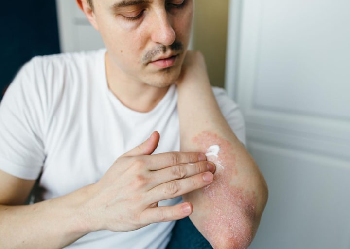 خارش پوست بعد از حمام