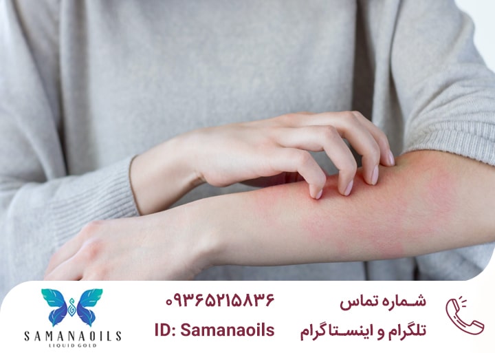 درمان خارش پوست بعد از حمام