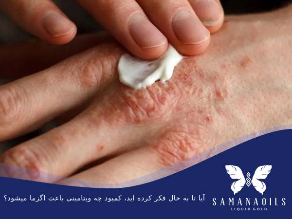 آیا تا به حال فکر کرده اید، کمبود چه ویتامینی باعث اگزما میشود؟