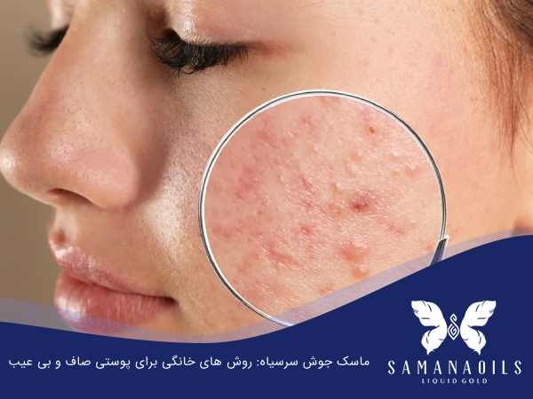 ماسک جوش سرسیاه