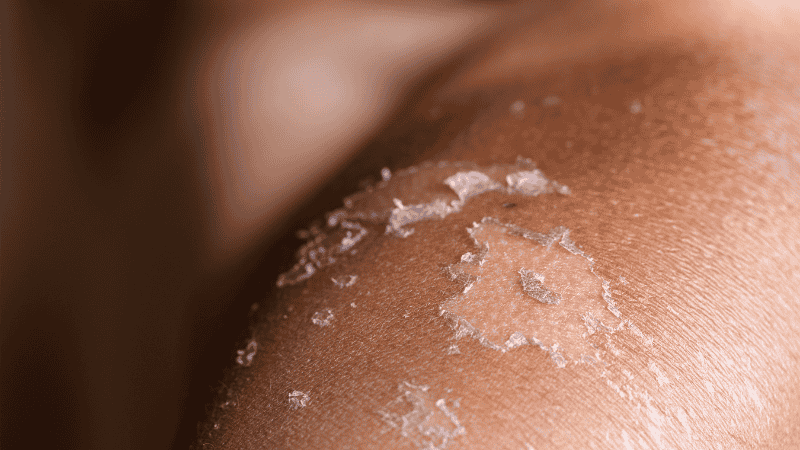 درمان آفتاب سوختگی