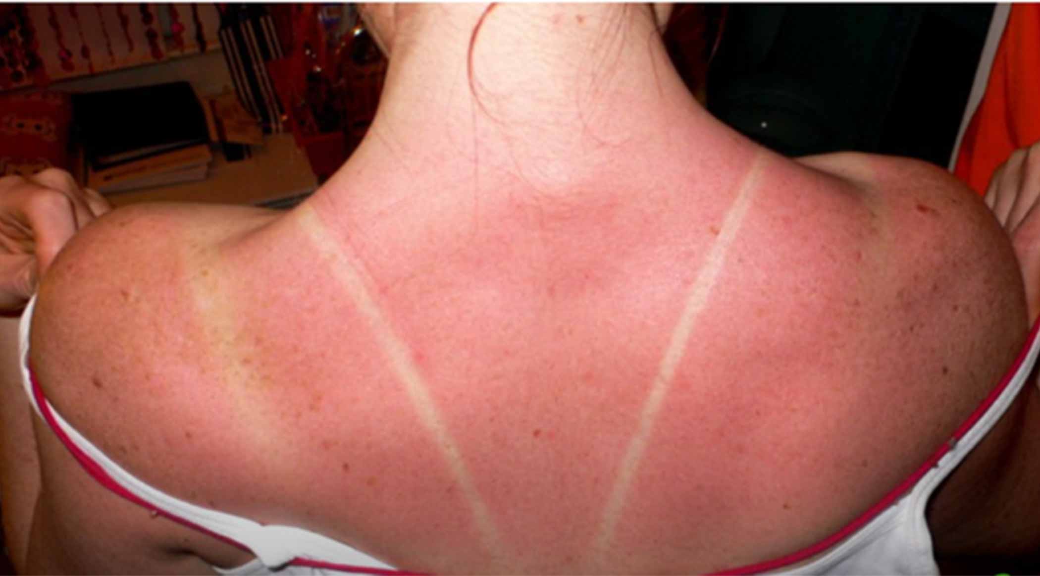 درمان خانگی آفتاب سوختگی