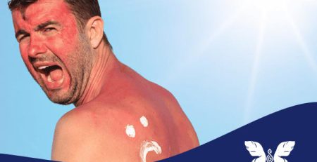 درمان خانگی آفتاب سوختگی