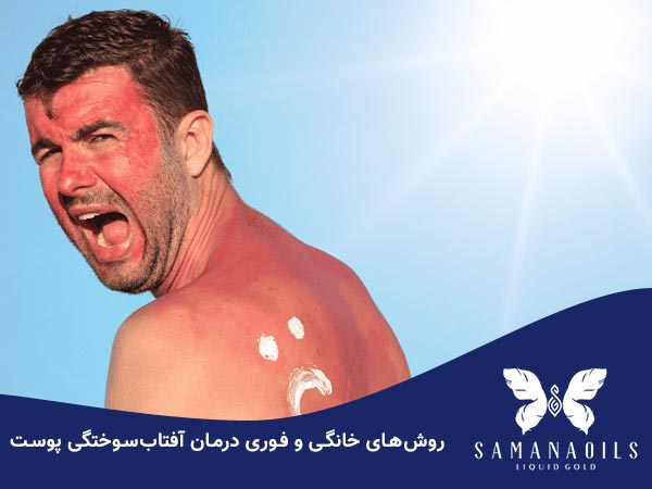 درمان خانگی آفتاب سوختگی