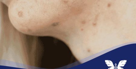 درمان جوش گردن