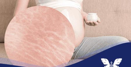 درمان قطعی ترک های پوستی