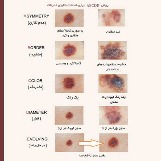 لک های پوستی خطرناک