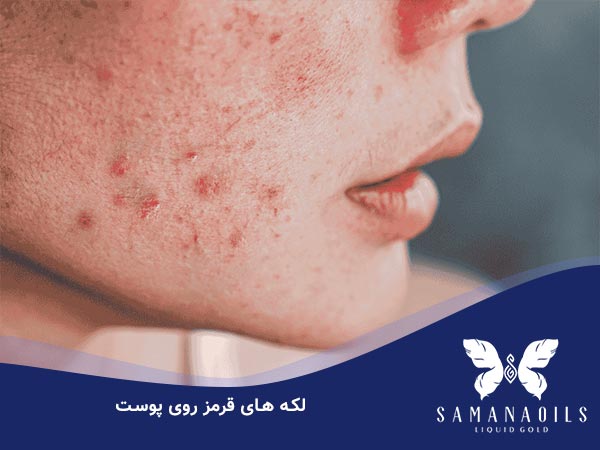 لکه قرمز روی پوست