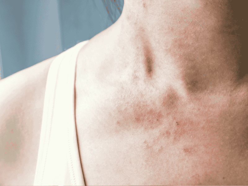 لکه های قرمز پوست