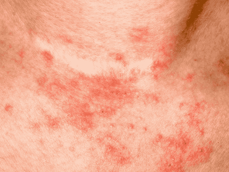 لکه های قرمز پوست
