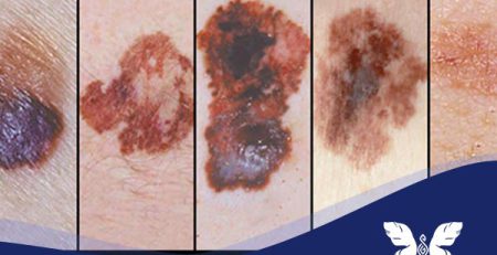 لکه های پوستی خطرناک کدامند