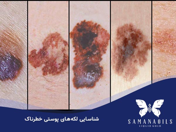لکه های پوستی خطرناک کدامند