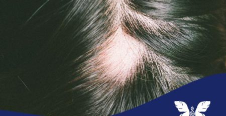 درمان قطعی ریزش موی سکه‌ای (آلوپسی آره‌آتا)