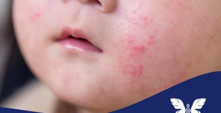 حساسیت پوستی کودکان