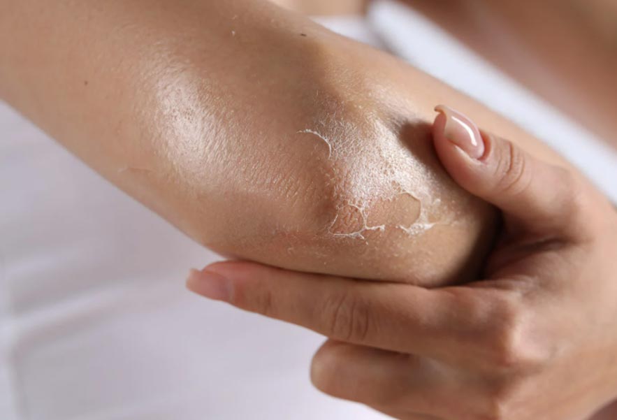 خشکی پوست در سرما