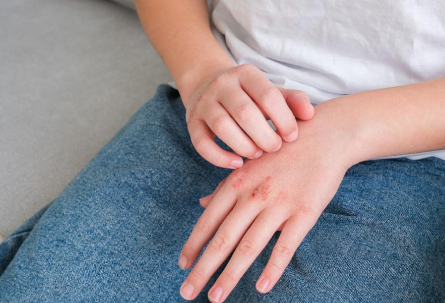 درمان خشکی پوست در سرما