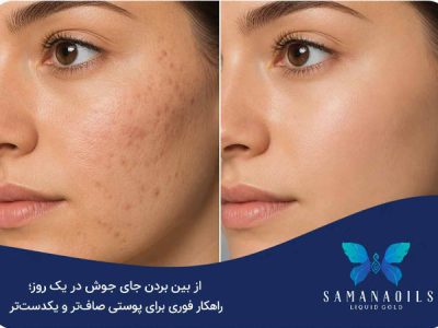 از بین بردن جای جوش در یک روز